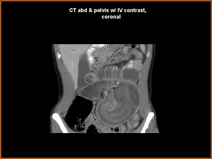 CT abd & pelvis w/ IV contrast, coronal 