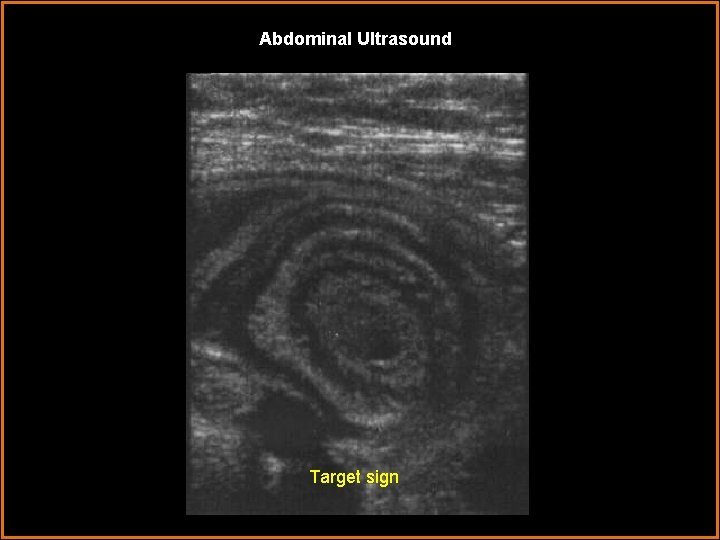 Abdominal Ultrasound Target sign 