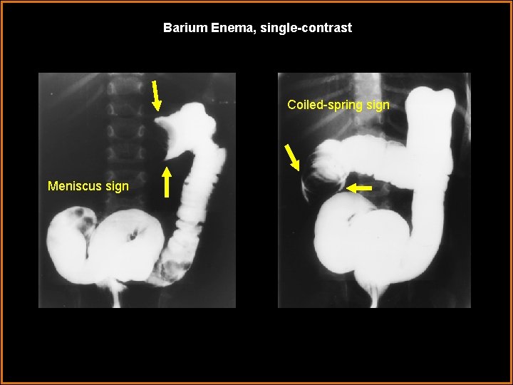 Barium Enema, single-contrast Coiled-spring sign Meniscus sign 
