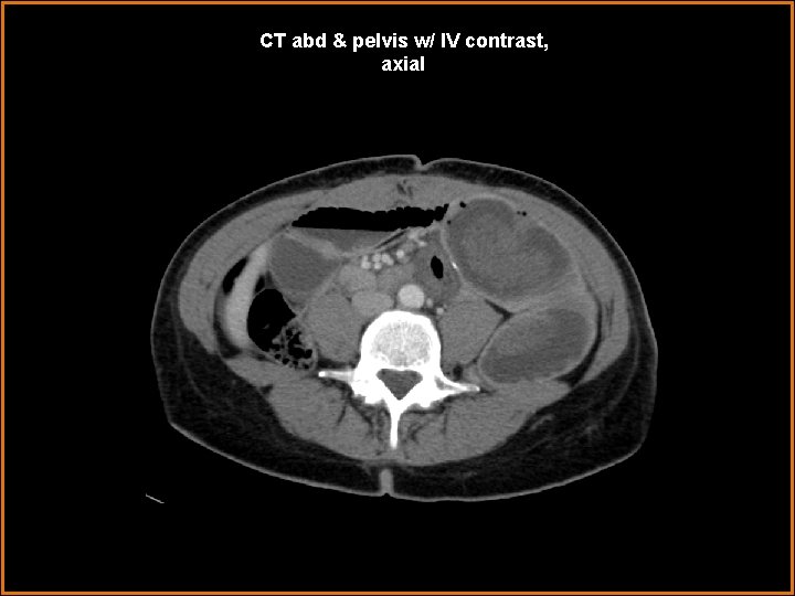 CT abd & pelvis w/ IV contrast, axial 