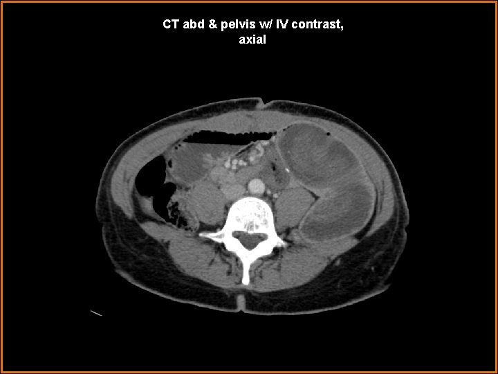 CT abd & pelvis w/ IV contrast, axial 