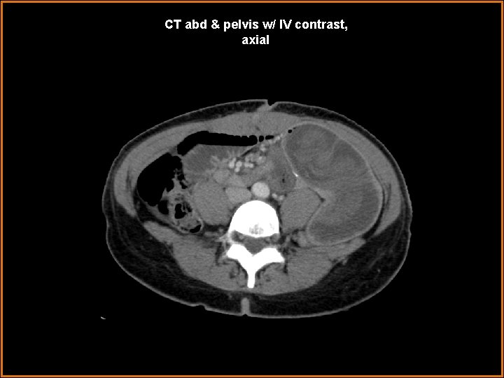 CT abd & pelvis w/ IV contrast, axial 