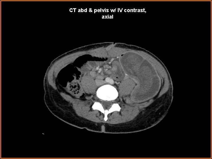 CT abd & pelvis w/ IV contrast, axial 