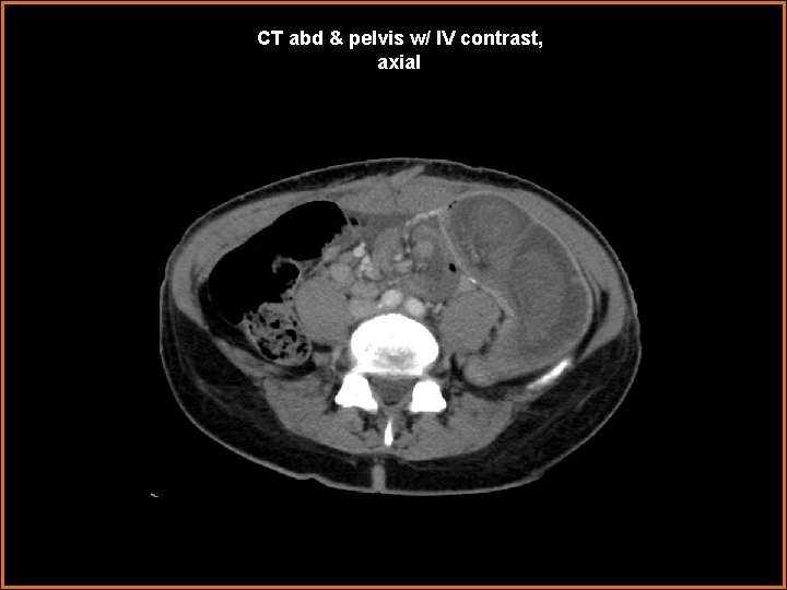 CT abd & pelvis w/ IV contrast, axial 