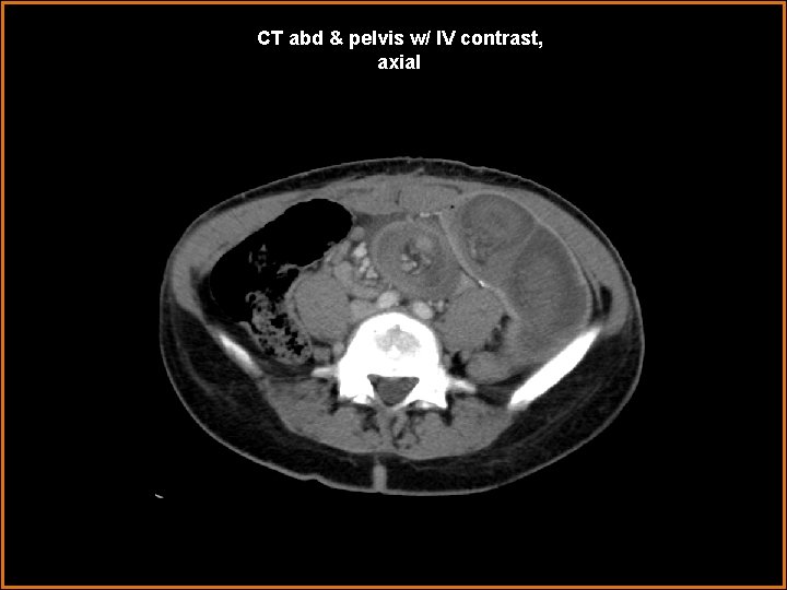 CT abd & pelvis w/ IV contrast, axial 