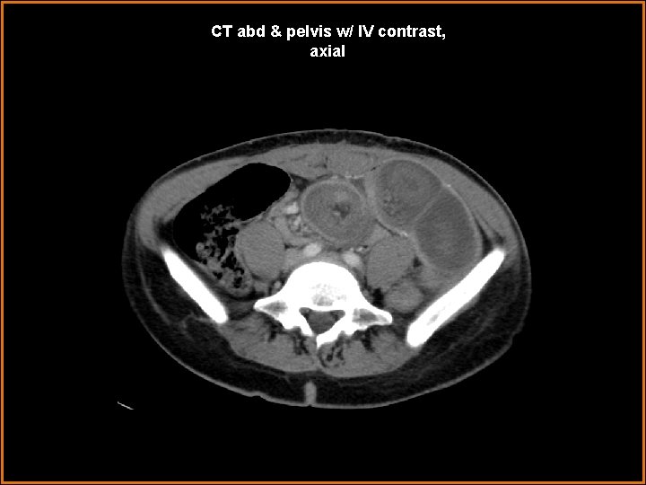 CT abd & pelvis w/ IV contrast, axial 