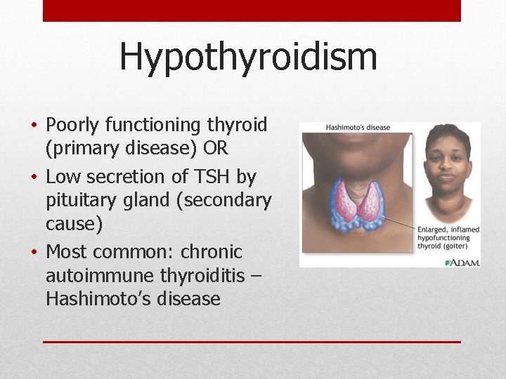 Hypothyroidism • Poorly functioning thyroid (primary disease) OR • Low secretion of TSH by Hypothyroidism • Poorly functioning thyroid (primary disease) OR • Low secretion of TSH by