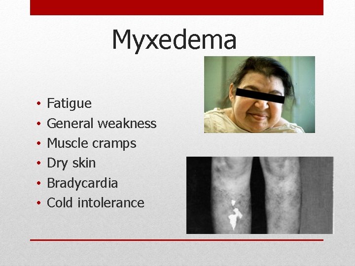 Myxedema • • • Fatigue General weakness Muscle cramps Dry skin Bradycardia Cold intolerance Myxedema • • • Fatigue General weakness Muscle cramps Dry skin Bradycardia Cold intolerance