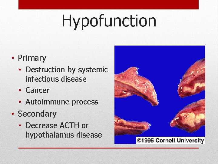 Hypofunction • Primary • Destruction by systemic infectious disease • Cancer • Autoimmune process Hypofunction • Primary • Destruction by systemic infectious disease • Cancer • Autoimmune process