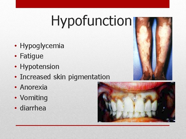 Hypofunction • • Hypoglycemia Fatigue Hypotension Increased skin pigmentation Anorexia Vomiting diarrhea Hypofunction • • Hypoglycemia Fatigue Hypotension Increased skin pigmentation Anorexia Vomiting diarrhea
