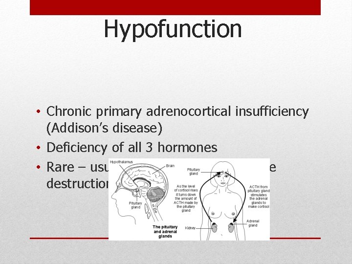 Hypofunction • Chronic primary adrenocortical insufficiency (Addison’s disease) • Deficiency of all 3 hormones Hypofunction • Chronic primary adrenocortical insufficiency (Addison’s disease) • Deficiency of all 3 hormones