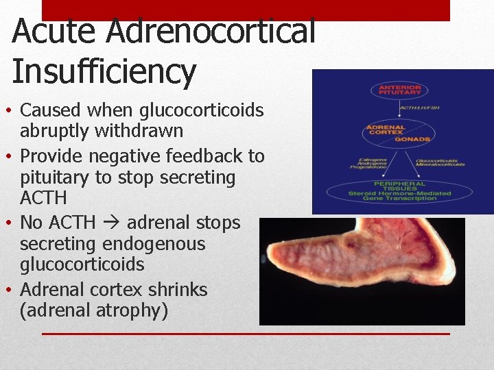 Acute Adrenocortical Insufficiency • Caused when glucocorticoids abruptly withdrawn • Provide negative feedback to Acute Adrenocortical Insufficiency • Caused when glucocorticoids abruptly withdrawn • Provide negative feedback to