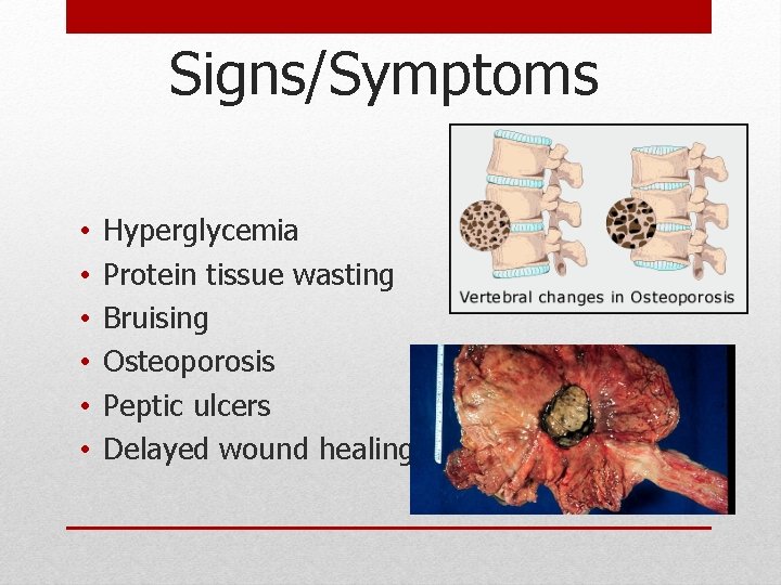 Signs/Symptoms • • • Hyperglycemia Protein tissue wasting Bruising Osteoporosis Peptic ulcers Delayed wound Signs/Symptoms • • • Hyperglycemia Protein tissue wasting Bruising Osteoporosis Peptic ulcers Delayed wound