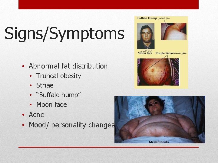 Signs/Symptoms • Abnormal fat distribution • • Truncal obesity Striae “Buffalo hump” Moon face Signs/Symptoms • Abnormal fat distribution • • Truncal obesity Striae “Buffalo hump” Moon face