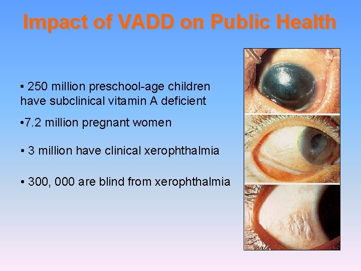 Impact of VADD on Public Health • 250 million preschool-age children have subclinical vitamin