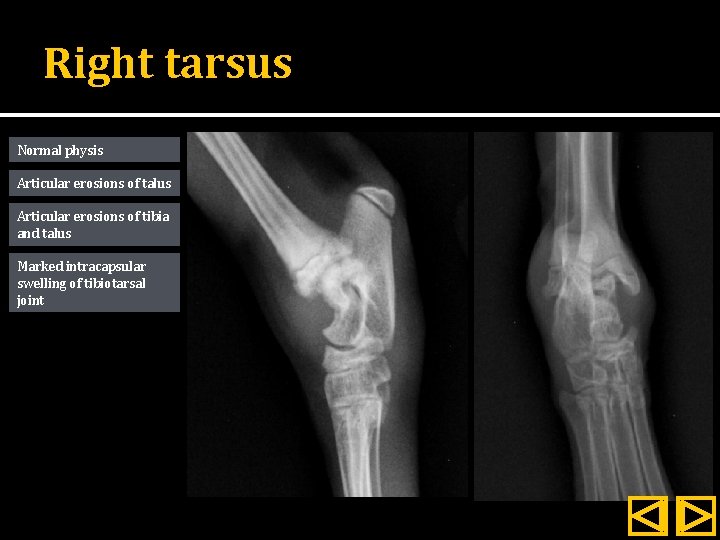 Right tarsus Normal physis Articular erosions of talus Articular erosions of tibia and talus