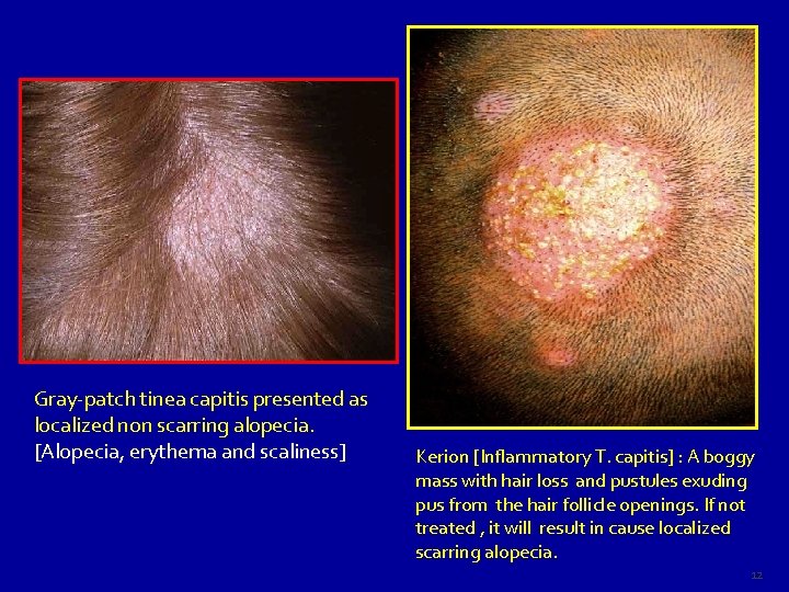 Gray-patch tinea capitis presented as localized non scarring alopecia. [Alopecia, erythema and scaliness] Kerion