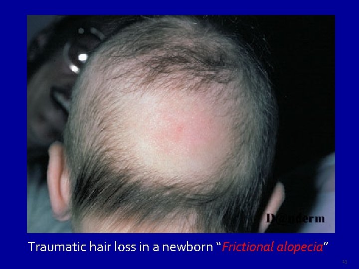 Traumatic hair loss in a newborn “Frictional alopecia” alopecia 13 