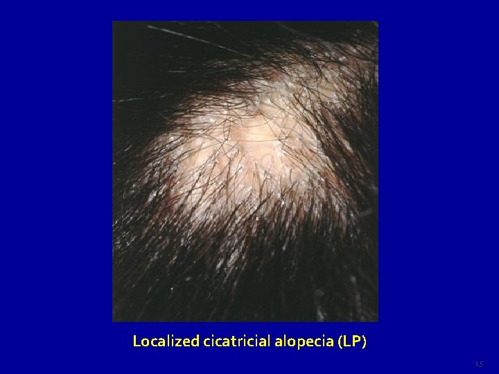 Localized cicatricial alopecia (LP) 15 