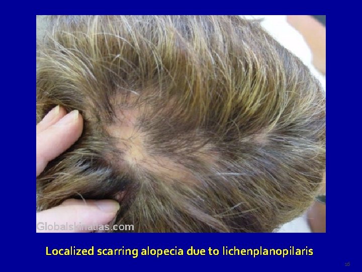 Localized scarring alopecia due to lichenplanopilaris 16 