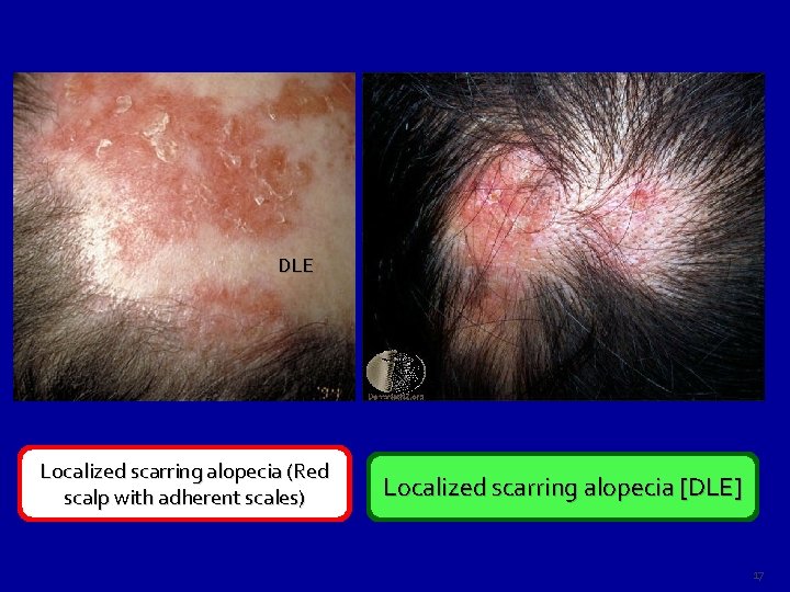 DLE Localized scarring alopecia (Red scalp with adherent scales) Localized scarring alopecia [DLE] 17