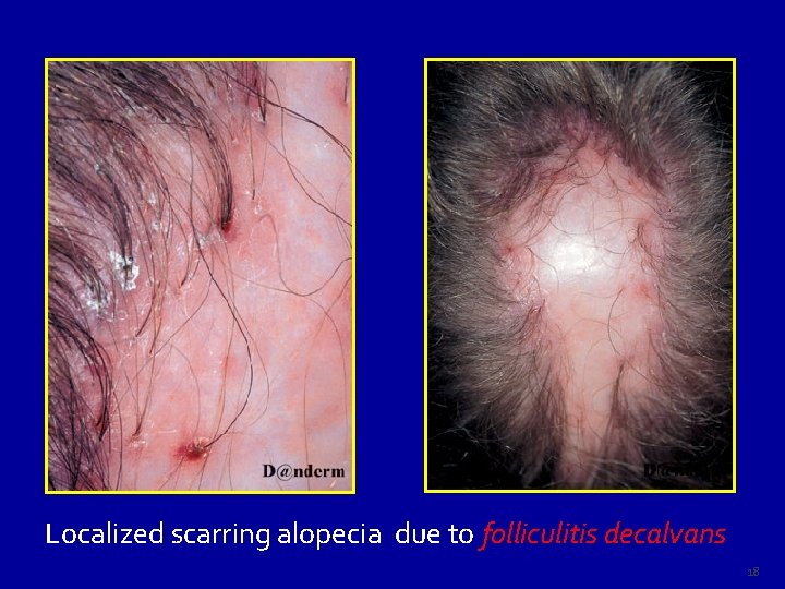 Localized scarring alopecia due to folliculitis decalvans 18 