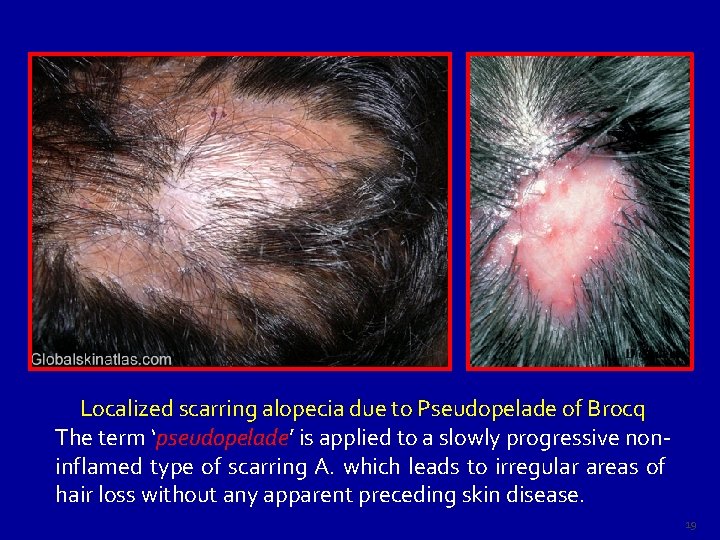 Localized scarring alopecia due to Pseudopelade of Brocq The term ‘pseudopelade’ pseudopelade is applied