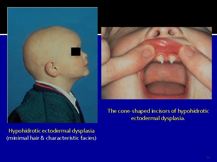 The cone-shaped incisors of hypohidrotic ectodermal dysplasia. Hypohidrotic ectodermal dysplasia (minimal hair & characteristic