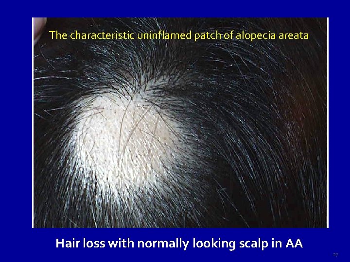 The characteristic uninflamed patch of alopecia areata Hair loss with normally looking scalp in