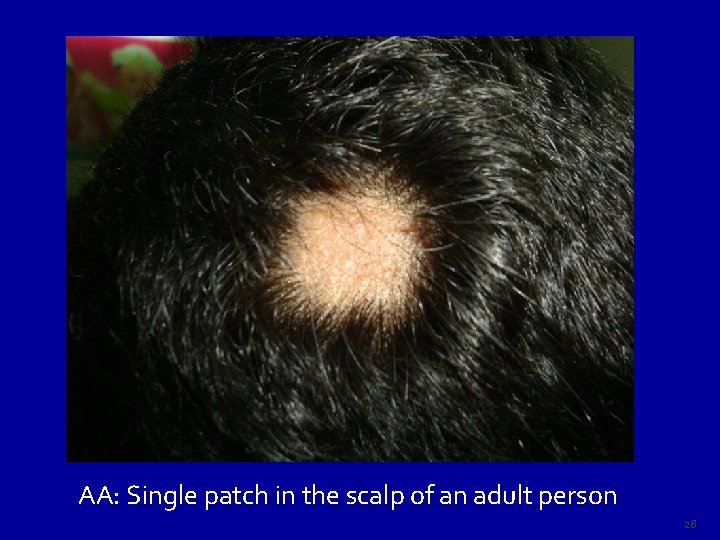 AA: Single patch in the scalp of an adult person 28 