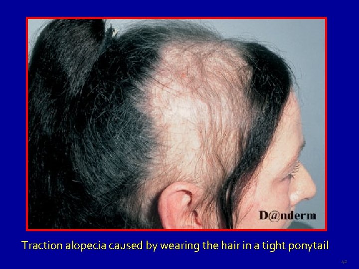 Traction alopecia caused by wearing the hair in a tight ponytail 42 