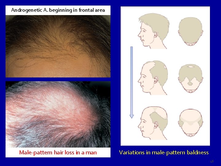 Androgenetic A. beginning in frontal area Male-pattern hair loss in a man Variations in