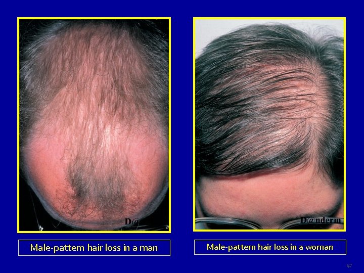 Male-pattern hair loss in a man Male-pattern hair loss in a woman 47 