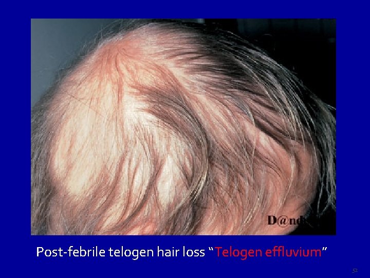 Post-febrile telogen hair loss “Telogen effluvium” 52 