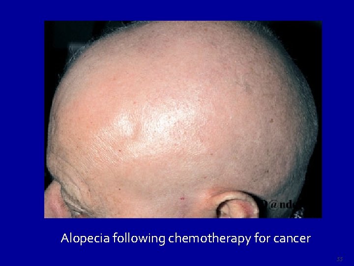 Alopecia following chemotherapy for cancer 55 