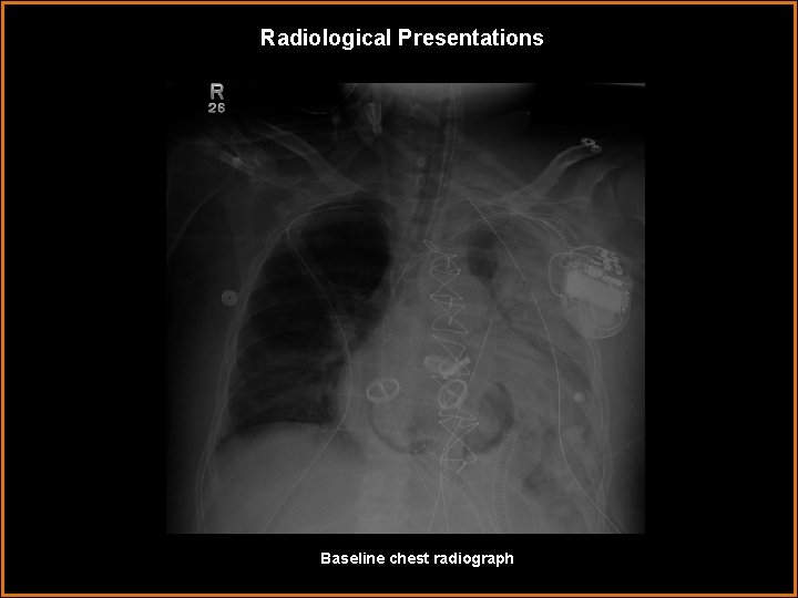 Radiological Presentations Baseline chest radiograph 