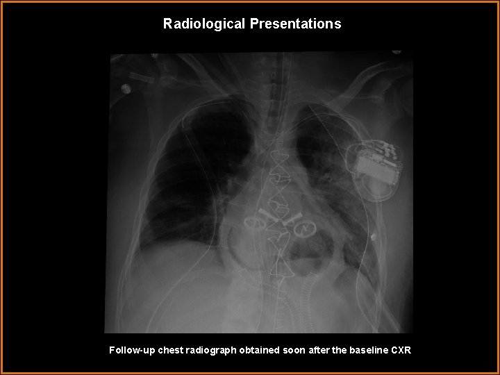 Radiological Presentations Follow-up chest radiograph obtained soon after the baseline CXR 