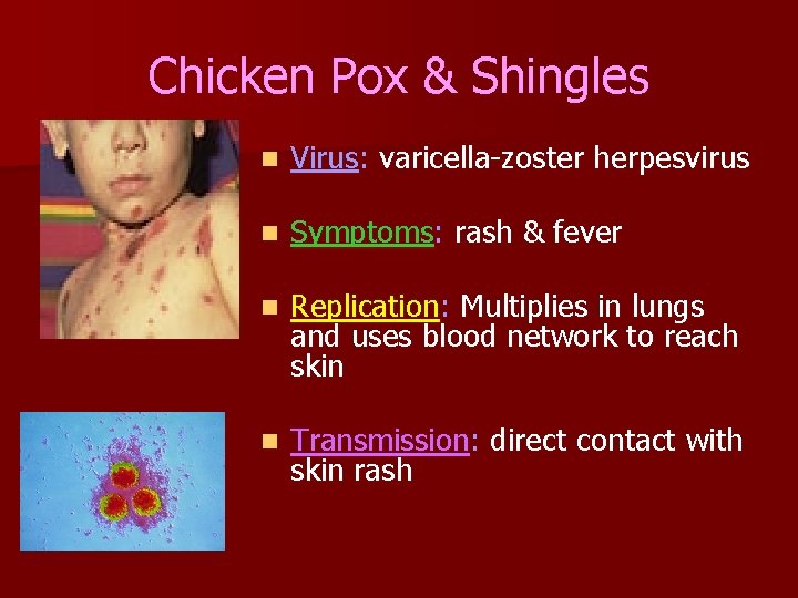 Chicken Pox & Shingles n Virus: varicella-zoster herpesvirus n Symptoms: rash & fever n