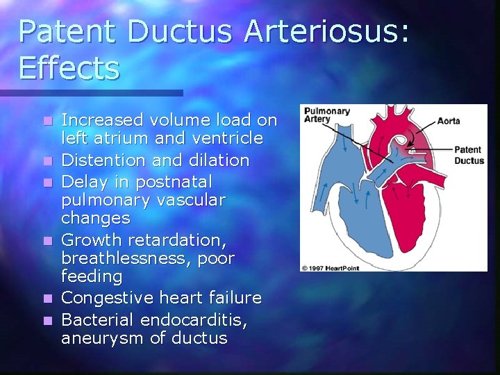 Patent Ductus Arteriosus: Effects n n n Increased volume load on left atrium and