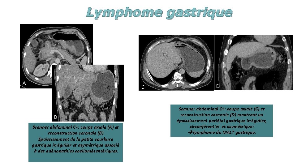 Lymphome gastrique A C B Scanner abdominal C+: coupe axiale (A) et reconstruction coronale