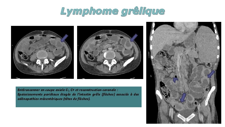 Lymphome grêlique Entéroscanner en coupe axiale C-, C+ et reconstruction coronale : Epaississements pariétaux