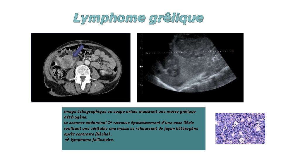 Lymphome grêlique Image échographique en coupe axiale montrant une masse grêlique hétérogène. Le scanner
