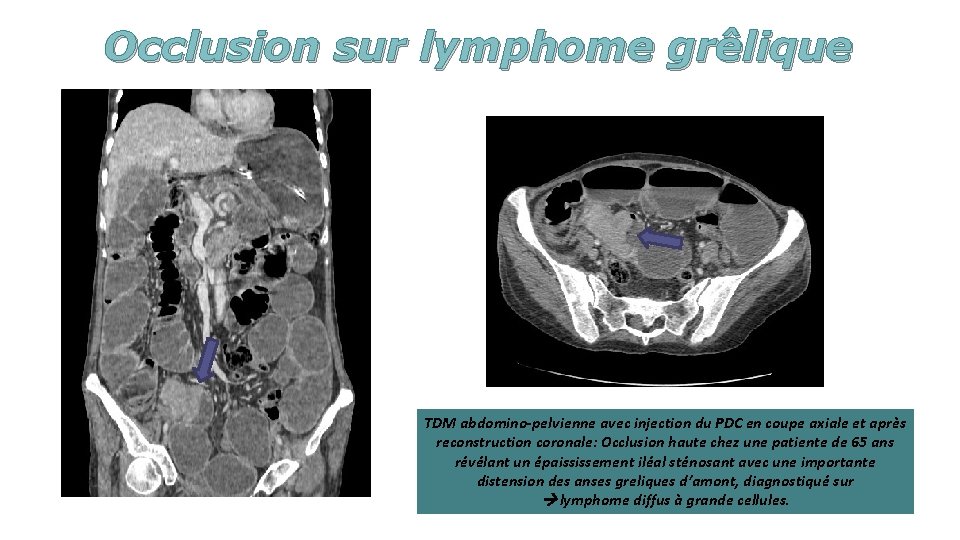 Occlusion sur lymphome grêlique TDM abdomino-pelvienne avec injection du PDC en coupe axiale et
