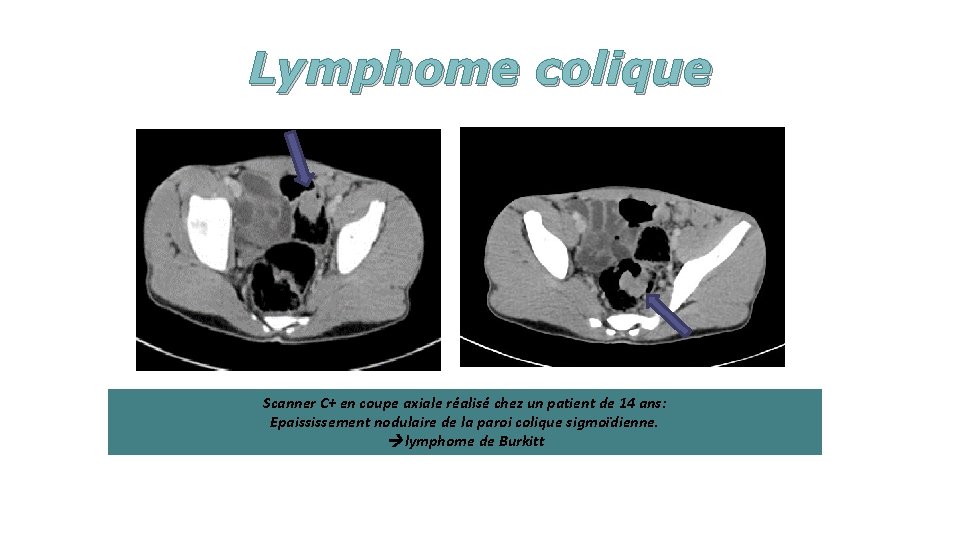 Lymphome colique Scanner C+ en coupe axiale réalisé chez un patient de 14 ans: