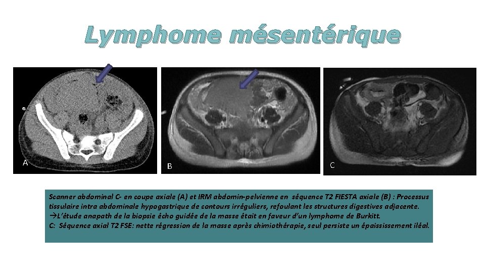 Lymphome mésentérique A B C Scanner abdominal C- en coupe axiale (A) et IRM
