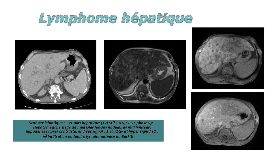 Lymphome hépatique Scanner hépatique C+ et IRM hépatique (T 2 FSE? T 1 FS,