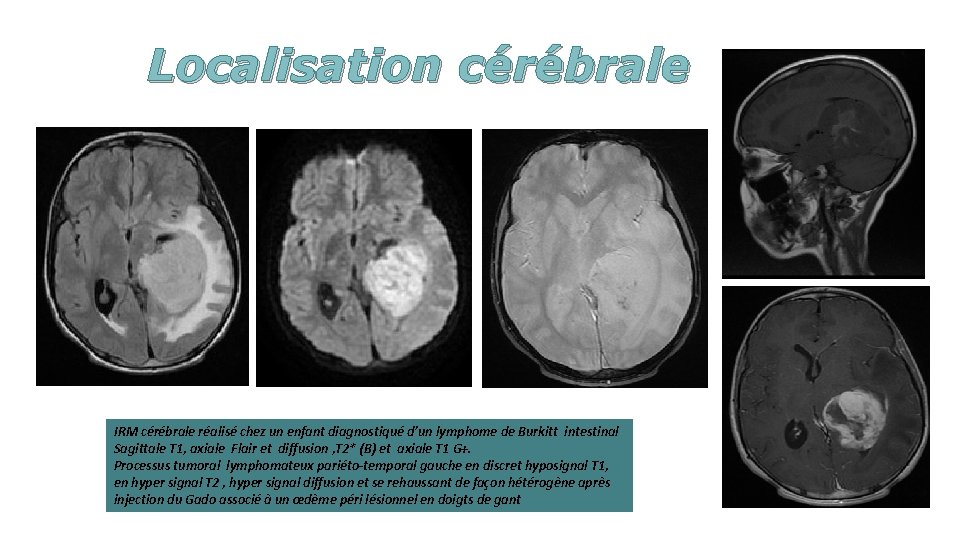 Localisation cérébrale IRM cérébrale réalisé chez un enfant diagnostiqué d’un lymphome de Burkitt intestinal