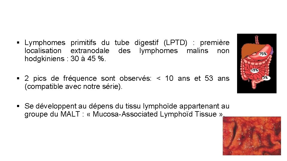 § Lymphomes primitifs du tube digestif (LPTD) : première localisation extranodale des lymphomes malins
