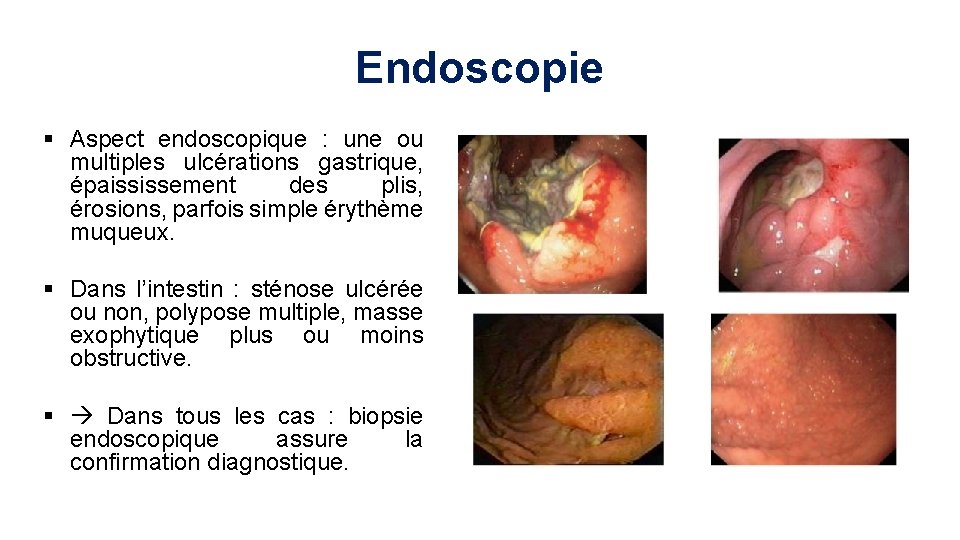 Endoscopie § Aspect endoscopique : une ou multiples ulcérations gastrique, épaississement des plis, érosions,
