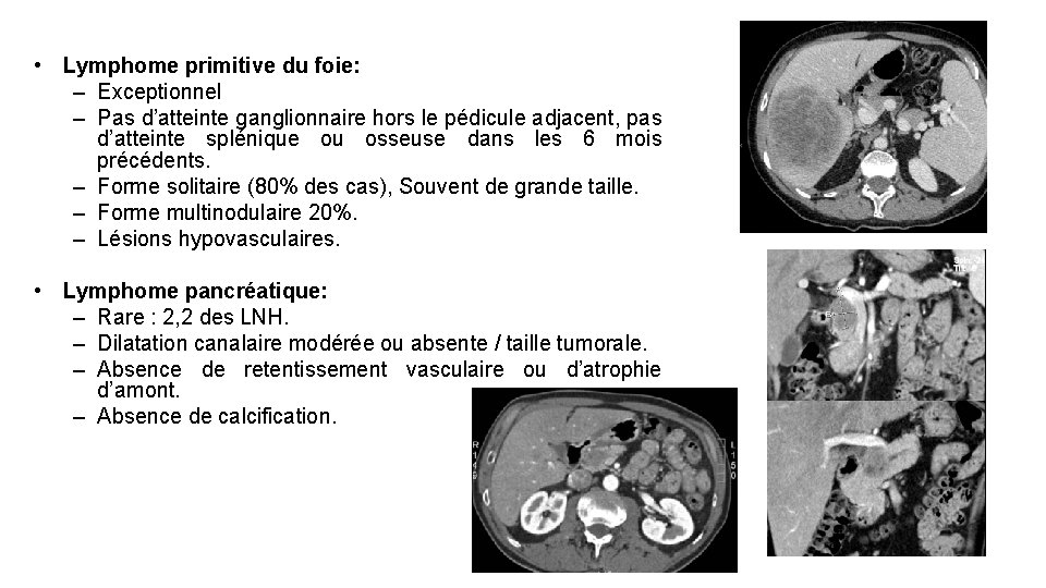 • Lymphome primitive du foie: – Exceptionnel – Pas d’atteinte ganglionnaire hors le